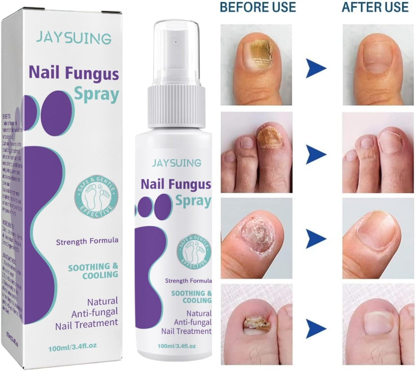 FUNGAL NAIL TREATMENT FOR TOENAILS EXTRA STRONG,100ML SPRAY FOR NAILS